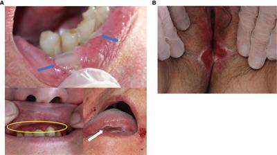 Mixed muco-cutaneous pemphigoid: Clinical and immunological features of 15 cases